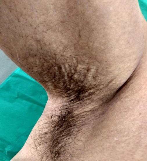 Figure 7: Skin colored smooth pedunculated swelling of 1X1 cm size over left chest. Skin from neck and left forearm was biopsied and subjected to staining with hematoxyllin - eosin and Von Kossa stains. It showed irregularly clumped faintly basophilic elastic fibres admixed with mucoid material in the mid and lower dermis (Figure 8). At one focus, basophilic dense calcified deposits were seen. No evidence of inflammatory cell infiltration. Hematoxylin and eosin stained section from the excisional biopsy specimen of swelling over left chest showed skin with underlying dermal circumscribed, nonencapsulated tumour composed of spindle cells arranged in fascicles. Spindle cells showed thin wavy