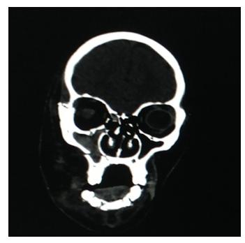 Figure 3: MPR image of Axial CT skull that visualized the fracture.