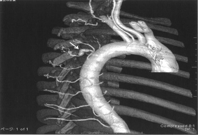 Figure 2: Three-dimensional computed tomographic angiography (3DCTA) at the presentation of sudden dyspnea and chest pain. White arrow indicates the fifth intercostal artery aneurysm. This shows the position of the aneurysm, the size of the aneurysm, and the form of the aneurysm.