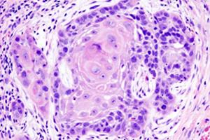 Figure 4: Transformation of Oral Lichen Planus to Oral Squamous Cell Carcinoma [12].