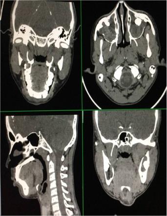 Figure 1: Coronal, sagittal and axial scans of CT scan face including cranium showing multiple odontogenic keratocysts of maxilla and calcification of falx cerebri.