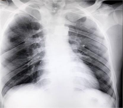 Figure 2: Chest X-Ray PA view showing multiple bifid and fused ribs.