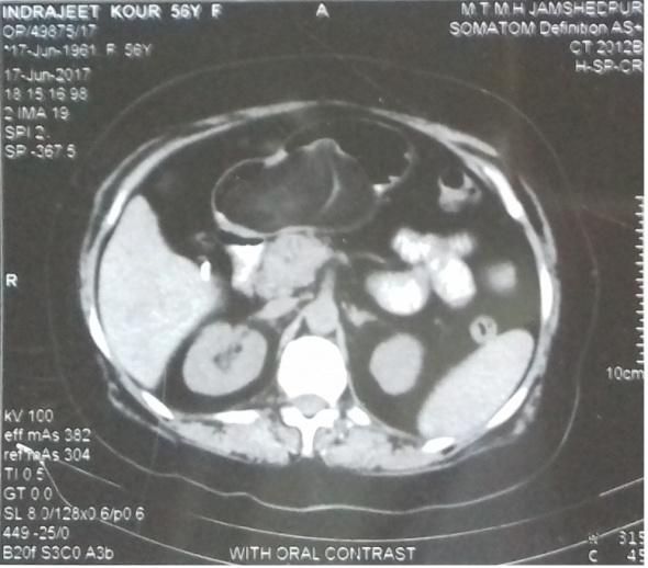 Figure 1: CECT film of abdomen showing gastric lipoma.