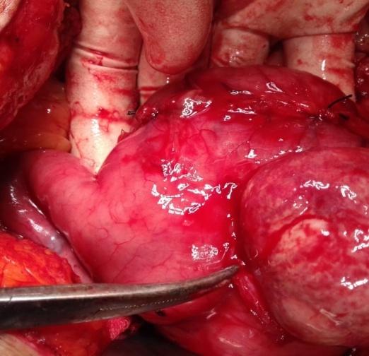 Figure 2: Operative photograph of Gastric lipoma. She underwent Diagnostic Laparoscopy and Exploratory Laparotomy on 2nd February. Diagnostic laparoscopy was done to rule out peritoneal and liver metastasis. The abdomen was opened using an upper midline incision. A firm mass was felt in distal portion of the body of stomach. Gastrotomy was done. (Figures 2 & 3) The posterior wall mucosa incised and submucosal lesion enucleated. The lesion was yellowish to white in colour, multilobulated, globular, smooth surface, firm in consistency measuring 8x6 cm. A Frozen section was sent and it was reported as LIPOMA. Closure was done.