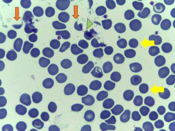 Figure 1: Peripheral blood smears showing microangiopathic hemolytic anemia. The smear presents schistocytes: helmet cells (orange arrows) and microspherocytes (yellow arrows). Fragmented red cells are also seen (green arrowhead). The platelet number is reduced.
