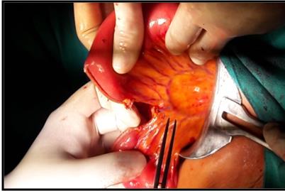 Figure 6: Disfunctional intestinal segment to create the Roux-en-Y loop. The patient evolves satisfactorily. The result of pathology reports fibrous cystic wall covered by a layer of reactive superficial epithelium, with focus of pseudo- pyloric metaplasia and presence of chronic inflammatory infiltration.