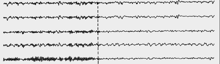 Figure 3: Changes in encephalograms before prayer and in the prayer process. It can be seen from the figures that, "Prayerful wakefulness" is recognized by neurophysiologists as the fourth state of the brain, along with the three main ones - wakefulness, slow and fast sleep, characterized by a characteristic suppression of the intensity of electrical impulses in the cerebral cortex. Such neurophysiologic processes occur regardless of what kind of faith a person professes. In addition, it should be noted that during prayer, the consumption of oxygen reduces about by 20% in a person praying, while during sleep the oxygen consumption reduces only by 8%. This suggests that a prayer leads to better functioning and recovery of the body to a greater extent than sleep.