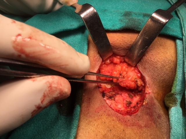 Figure 4: Karydakis flap surgery in progress Figure 5: Completed Karydakis flap
