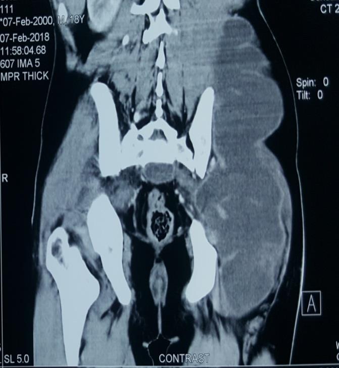 Figure 2: Pre-sacral collection with left sided gluteal, iliac, and ilio-psoas extension.