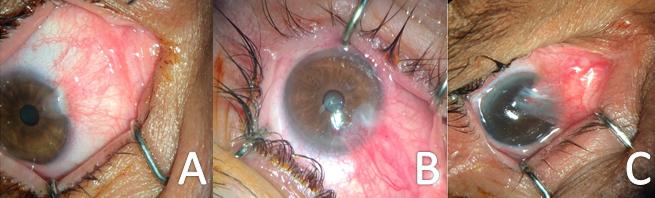 Figure 2: Grading of pterygium according to morphological characteristics. A) Grade T1 (atrophic) episcleral vessels underlying the pterygium clearly visible; B) Grade T2 (intermediate) episcleral vessels are partially obscured; C) Grade T3 (fleshy) episcleral vessels are completely obscured.