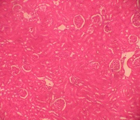Figure 5: Hemorrhage, congestion of blood vessels, tubular necrosis and Infiltration of inflammatory cells in interstitium in rats treated with 9mg/kg lithium carbonate (H&E X100).