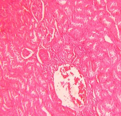 Figure 6: Server congestion coagulative necrosis of renal tubules in rats treated with 17 mg/kg lithium