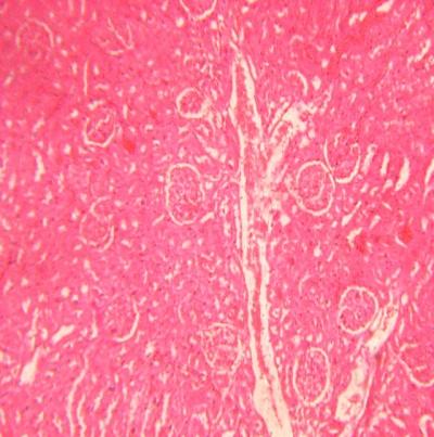 Figure 7: Sever congestion, tubular necrosis, scanty infiltration of inflammatory cells in rats treated with 34mg/kg lithium carbonate (H&E X100).