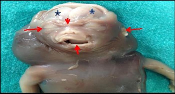 Figure 2: Facial dysmorphology: Hypertelorism, low set ears, flat nasal bridge & macrognathia. Skin over scalp withdrawn& parietal bones are visualized.