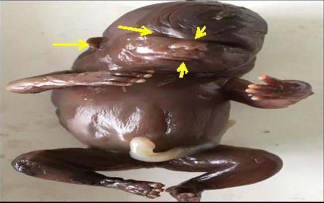 Figure 4: Facial dysmorphology Hypertelorism, flat nasal bridge, low set ears & micrognathia.