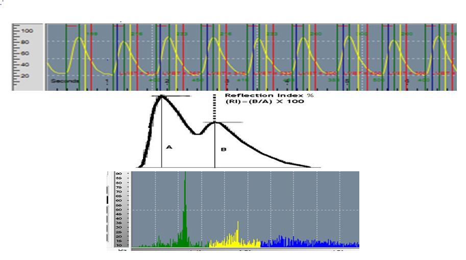 Figure 1: TM-Oxi: Pulse Wave Analysis: Endothelial Function (Courtesy: Dr Albert Maarek). In order to understand the last mile events that play a very important role in the development of acute vascular (vulnerability) of plaque, flow dynamics and thrombotic or hemorrhagic status of the circulating blood (Figure 2).