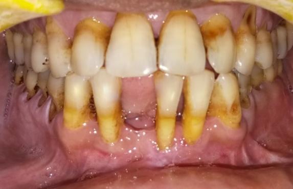 Figure 7: 1 Month Post – Operative.