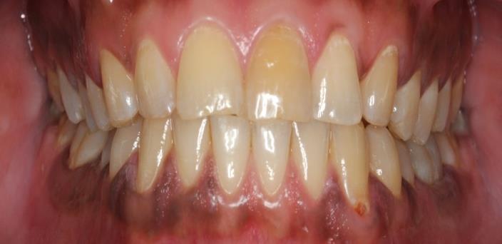 Figure 2: The left central incisor was non vital and discoloured.