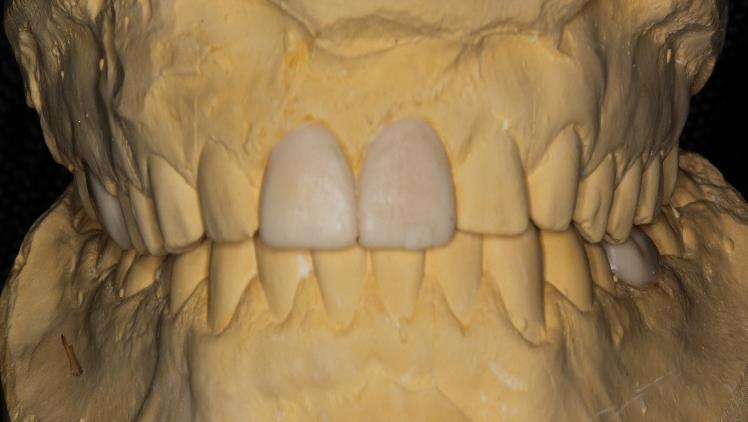 Figure 3: The 2/3 apical of the canal of #21 were calcified. Static and functional occlusion revealed non-functional anterior guide with posterior interferences. After clinical examination, radiographs, photographs, study casts, and diagnostic wax setup were undertaken (Figure 4).