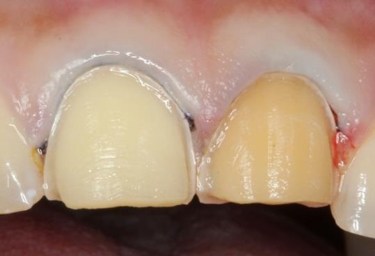 Figure 6: Wrapped-around preparation of the incisal edge. The main rule to respect is to avoid the palatal extension of the preparation in the zone of palatal concavity. That part of the palatal surface is the place of the maximum tensile stresses generated during loading. For moderate crown fracture that involved incisal one third, it was recommended to make butt margin which limited the extension of the ceramic and reduced the amount of stress at tooth/veneer interface [11]. In addition, a horizontal butt margin is correct choice for fractured teeth, especially from the aspect of future adhesive bonding, which would be obtained with enamel. The overlapped incisal edge preparation is useful in circumstances where it is necessary to change the tooth dimensions or to protect part of the palatal surface. The finish line should be minimum 1mm away from centric contacts. The veneer extended onto the lingual surface will enhance mechanical retention and increase the surface area for bonding [4]. Preparation of the proximal area is crucial and care must be taken to ensure that the restoration–tooth interface is hidden. The adjacent tooth was protected with a metal matrix. The chamfer finish line was placed as lingually as permitted by the tooth anatomy and the preparation was stopped just short of the interproximal contact. Temporary restoration was done (Figure 7) with light cured composite resin or by resin acryl using the silicone index. It aimed to protect dental tissues and re- establish tooth shape and it was bonded to the teeth only at 2 to 3 spots with composite resin.