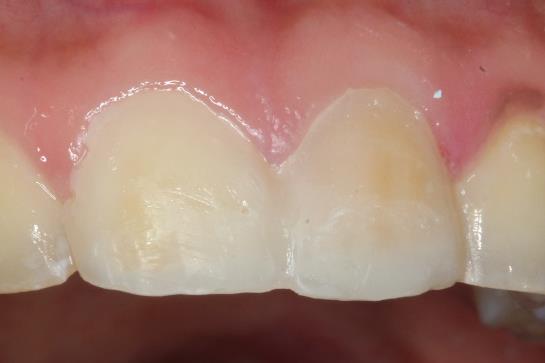 Figure 7: Temporary restorations. Gingival displacement was obtained using retraction cords (#000 and #00, Ultradent) and the impression was made with polyvinylsiloxane by putty-wash technique after removing retraction cords and the impression was checked and poured with die stone. Ceramic shade was selected as 3 L 1.5 prior to the preparation intended for the veneers. The veneers were fabricated in the lab using pressing technique (Ips-emax ingots). After removing the temporary veneers, the teeth were cleaned and washed with water or slurry of fine flour of pumice and were dried. The porcelain veneers were tried on to the teeth with selected shade of try in paste to verify their color and fit (Variolink Veneer Try-In Amherst, USA)) that simulated the final shade of restorations. Functional occlusion was controlled to verify the anterior guidance with absence of interferences. After completion of the try- in stage and determination of the cement color a gingival retraction cord was used to prevent contamination by gingival fluid. The inner surfaces of the veneers were etched with 9.5% hydrofluoric acid for 20 second and salinized with a silane coupling agent (Monobond Plus, Ivoclar Vivadent). The teeth surface were etched for 20 seconds with37% phosphoric acid then rinsed for 20 seconds.