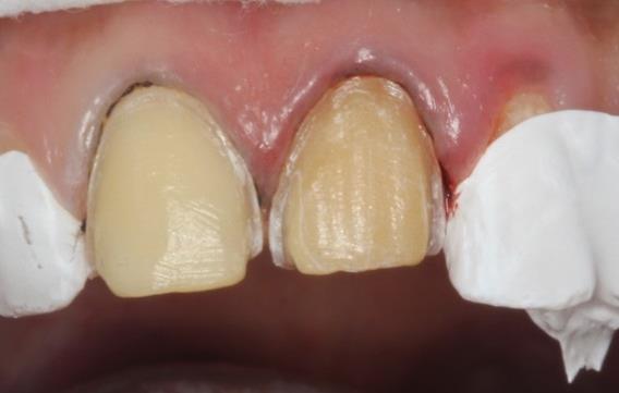 Figure 8: Protection of adjacent teeth during cementation.