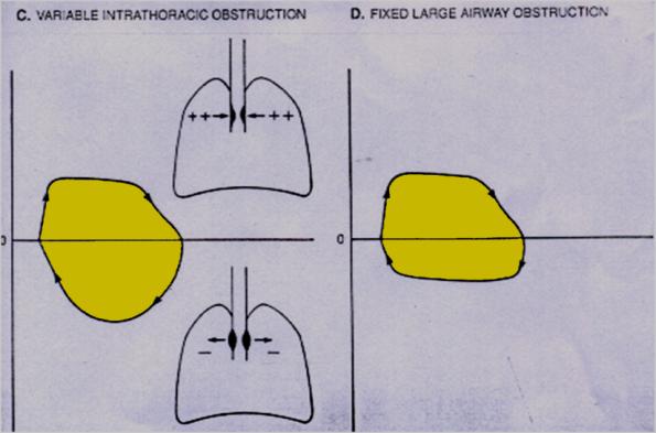 Figure 6: Flow Volume loop.