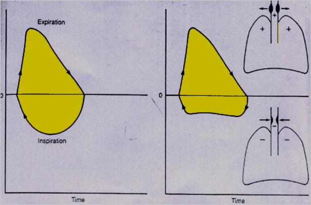 Figure 7: Flow Volume loop.