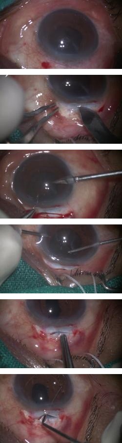 Figure 1: Surgical Steps