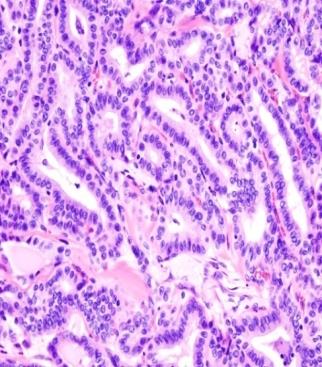 Figure 4: Medullary carcinoma(dispersed cell pattern either cuboidal or spindle shaped in a background of amorphous pink violet amyloid material)