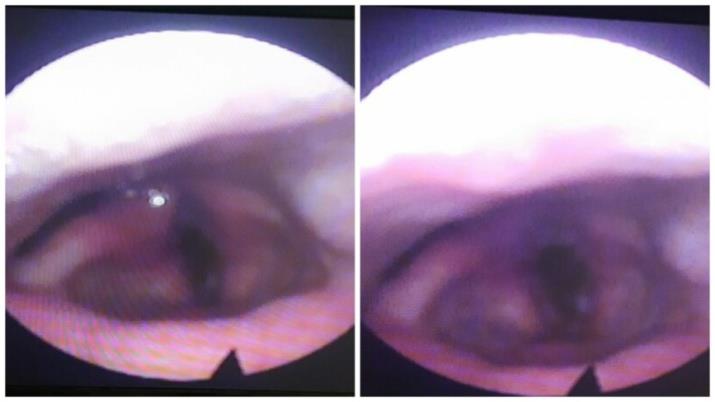 Figure 1: Video laryngoscopy showing the diffuse edema of the throat. The patient carried out a panendoscopy showing edematous appearance throughout the extra glottal region with diffuse inflammation. A biopsy was done. In the nasal endoscopy, burgeoning mass of the right side wall of the nasopharynx bleeding on contact. A biopsy was done too (Figure 2).