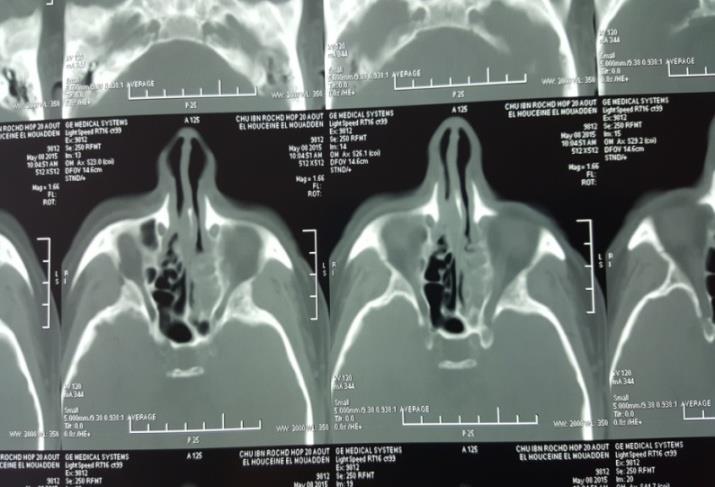 Figure 3: CT scan of face showing mass of nasopharynx and ethmoid cells in axial section.
