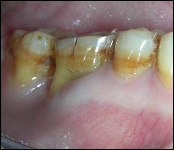 Figure 3: Post obturation radiograph.