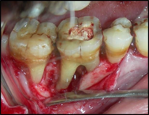 Figure 4: Full thickness flap elevation.