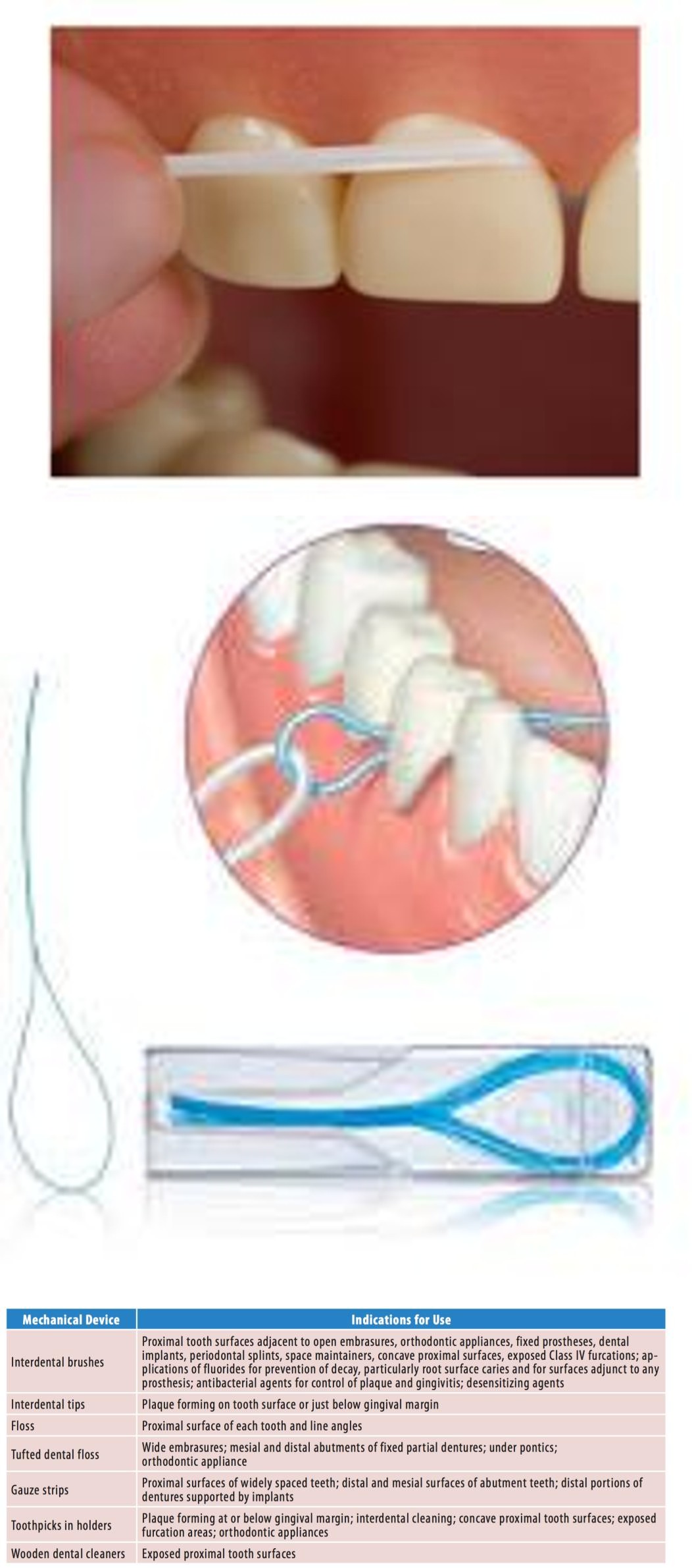 Figure 3: Various types of Dental Floss. Dental floss is available in various forms a) Waxed / Non waxed b) Orthodontics floss with holder c) Material- silk, nylon, expanded Polytetrafluoroethylene d) Twisted/non-twisted e) Thick/thin f) Bonded / Non bonded