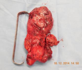 Figure 1: Cervico-thoracic Scanner coronal section showing a density evoking a plunging goiter in the anterior mediastinum and measuring128mm height.