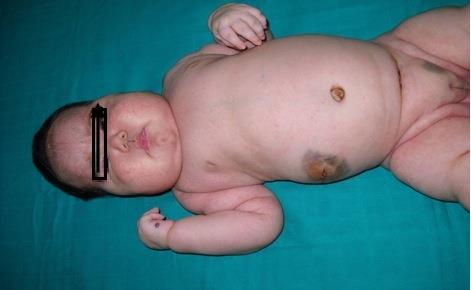 Figure 1: Cutaneous nodules at diagnosis.