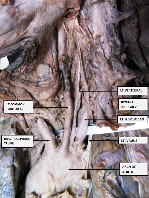 Figure 1: Dissection Of Arch Of Aorta With Its Branches Showing The Left Vertebral Artery Arising In Beteen Left Common Carotid And Left Subclavian Artery.