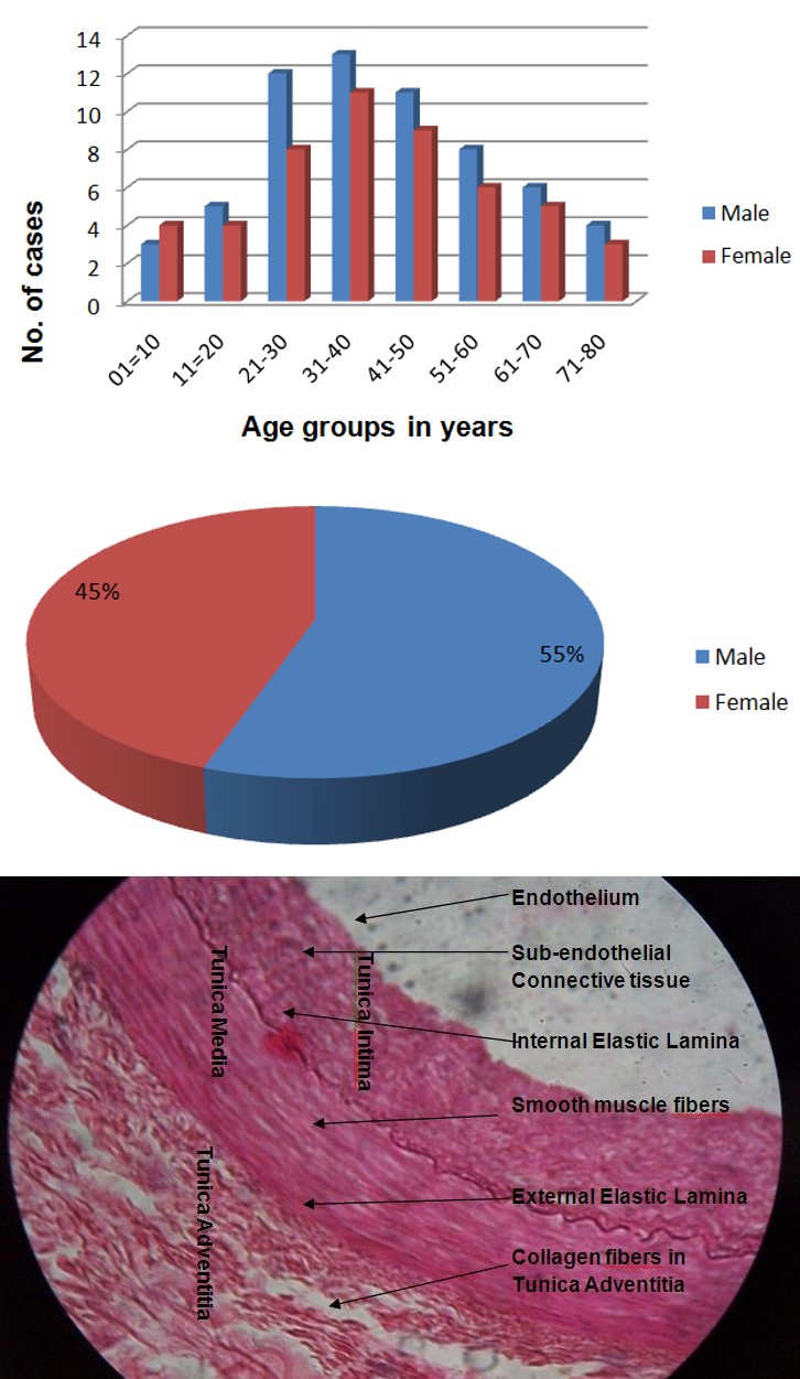 Figure 1: Showing Normal Histological Structure of Coronary Arterial Wall.