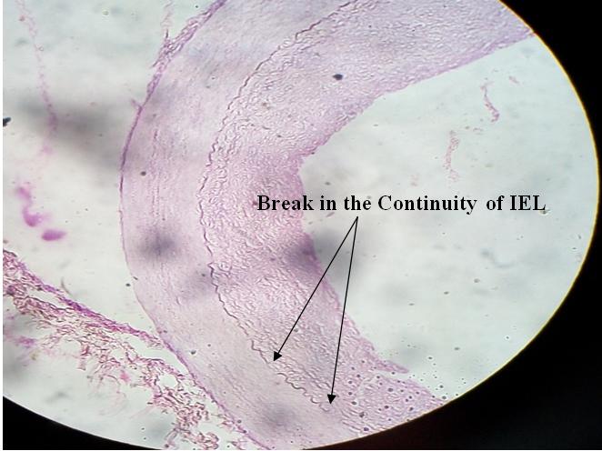 Figure 3: Showing Grade-I Degeneration of Internal Elastic Lamina (IEL).