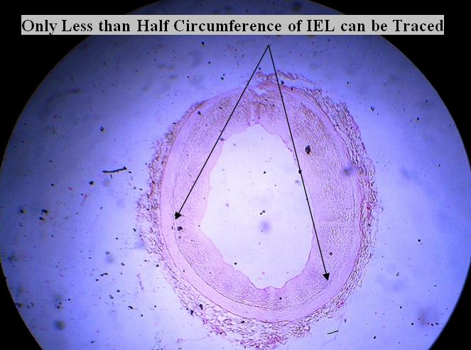 Figure 4: Showing Grade-II Degeneration of Internal Elastic Lamina (IEL).