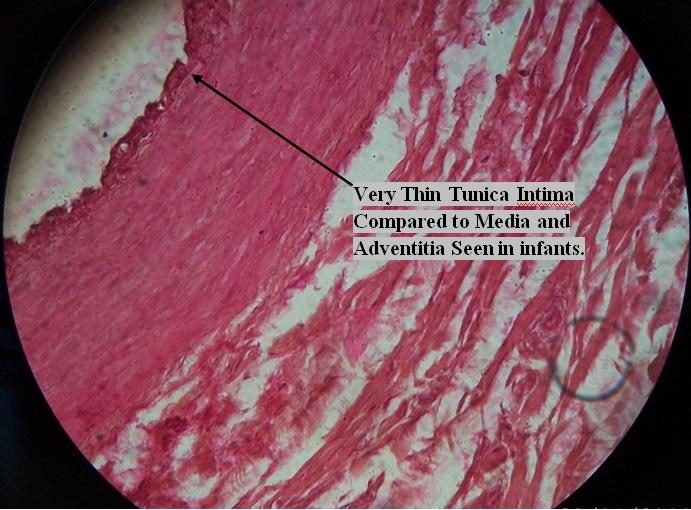 Figure 7: Showing Coronary Artery of Male in Eighth Decade.
