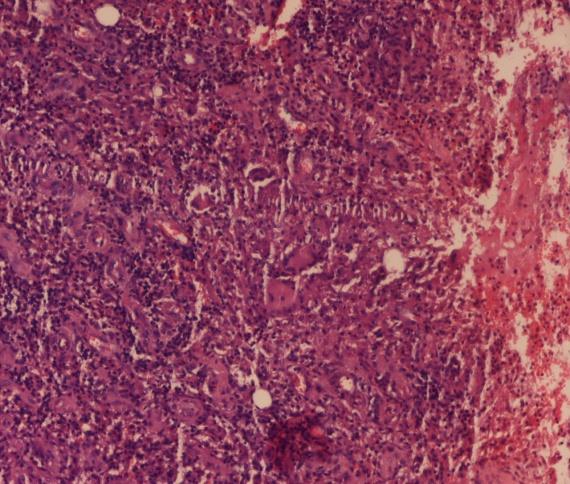 Figure 3: Tissue section showed several epithelioid cell granulomas comprising of langhan’s giant cells, histiocytes, lymphocytes with foci of caseous necrosis and scattered atypical cells. Hematoxylin & Eosin x 10X.