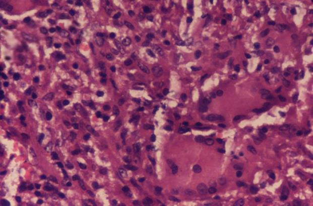 Figure 4: Microscopic section showed several epithelioid cell granulomas comprising of langhan’s giant cells, epithelioid cells, lymphocytes with foci of caseous necrosis. Hematoxylin & Eosin x 40X.