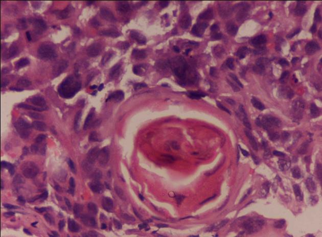 Figure 5: Tissue section shows irregular sheets of highly atypical squamoid cells with hyper chromatic nucleus and prominent nucleoli, involving the underlying tissue with keratin pearl formation. Hematoxylin & Eosin x 40X.