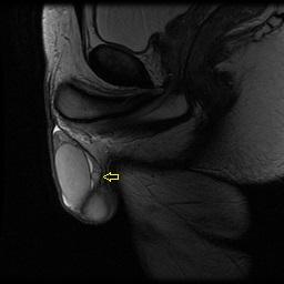 Figure 2: Testicular MRI shows well vascular zed undetermined nodule, independent from the surrounding structures.