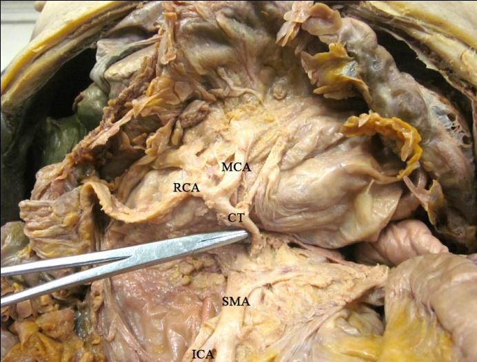 Figure 2: A common trunk shared between the right colic artery and middle colic artery. (SMA: superior mesenteric artery; ICA: ileocolic artery; RCA: right colic artery; MCA: middle colic artery; CT: common trunk of right colic artery and middle colic artery).