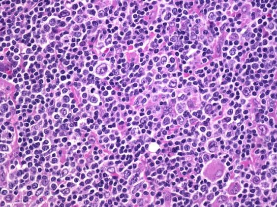 Figure 3: Lymphocyte predominance Hodgkin’Lymphoma [23].