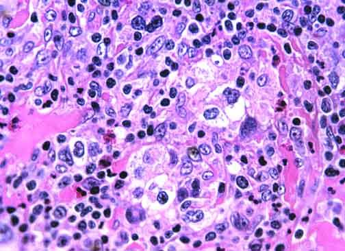 Figure 4: Mixed Cellularity Hodgkin’s Lymphoma [23].