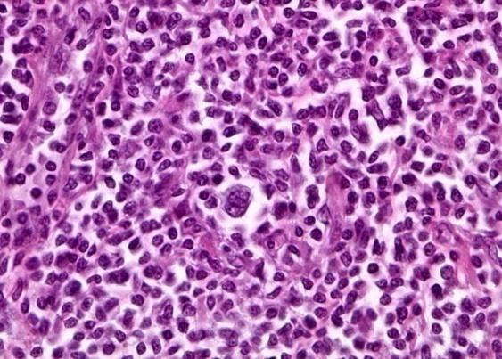 Figure 9: Popcorn or L & H Cell [23].